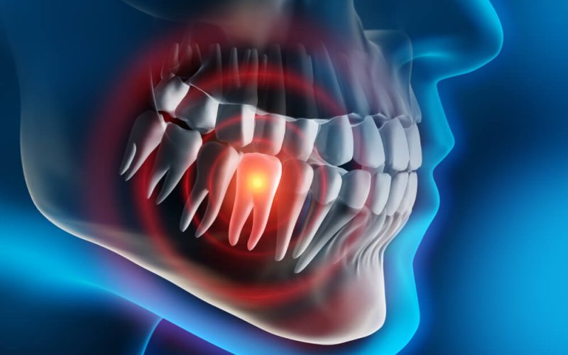 Endodoncia símptomas