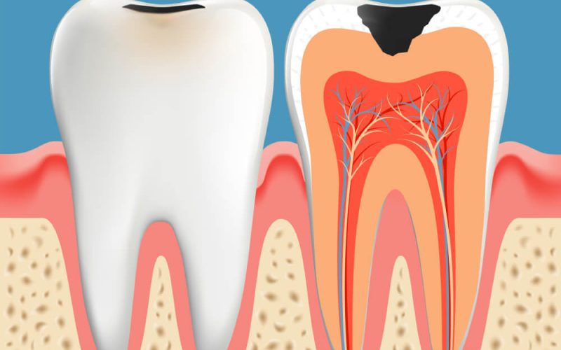 Endodoncia en Mataró