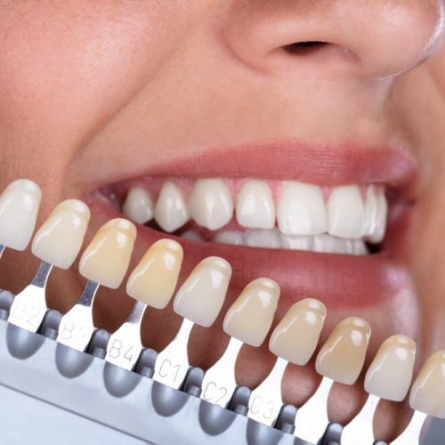 Tratamientos estética dental en mataro