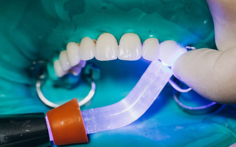 Estética dental blanqueamiento