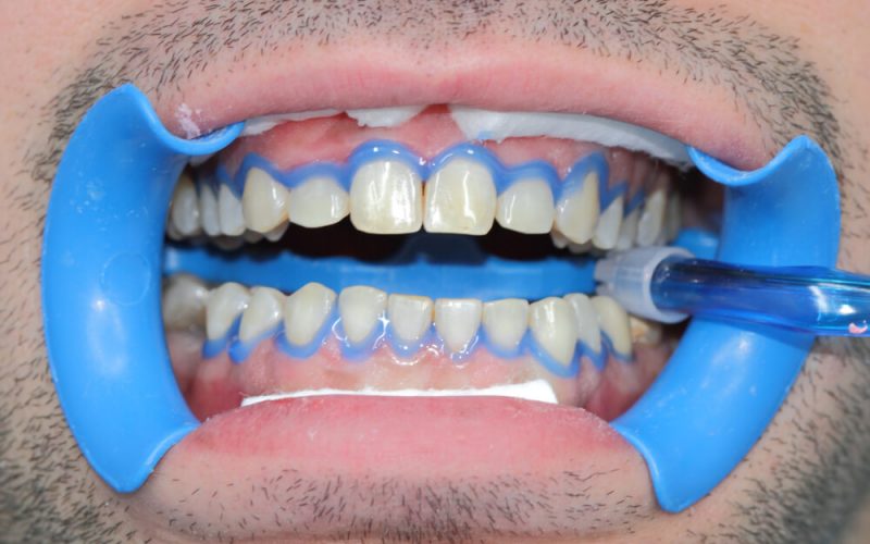 Mataró estética dental