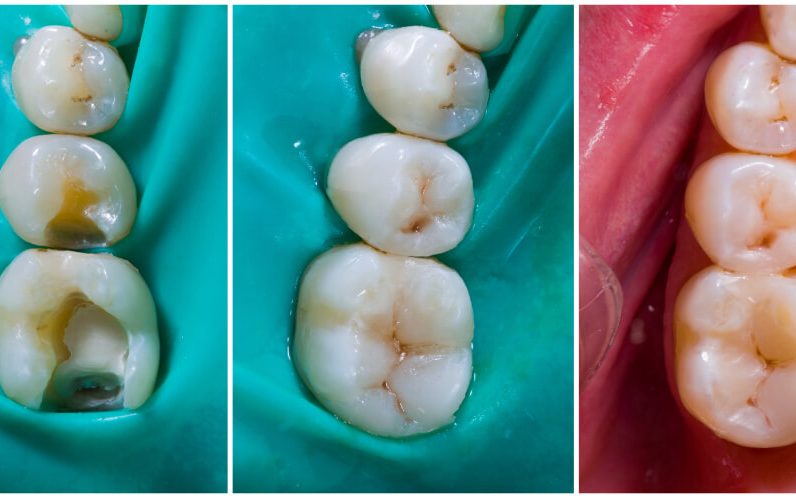 Odontología restauradora en mataró