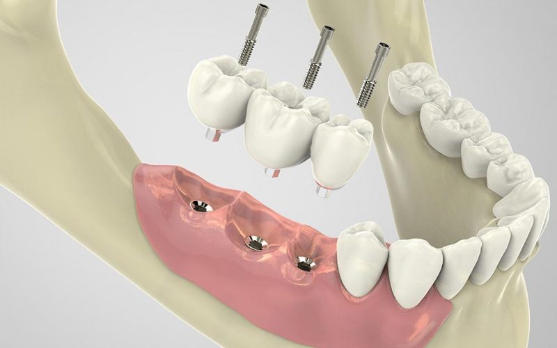 implantes dentales en mataró