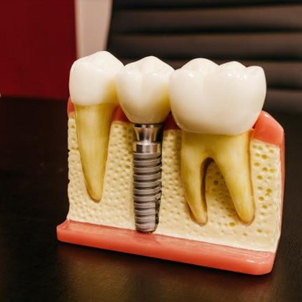 protesis dental mataro