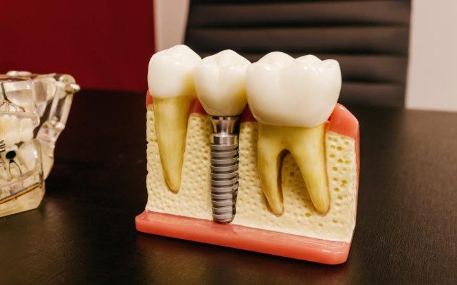 protesis dental mataro