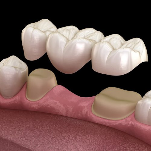 Tallado y colocación puente dental