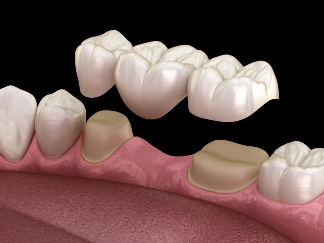 Tallado puente dental Tallado y colocación puente dental
