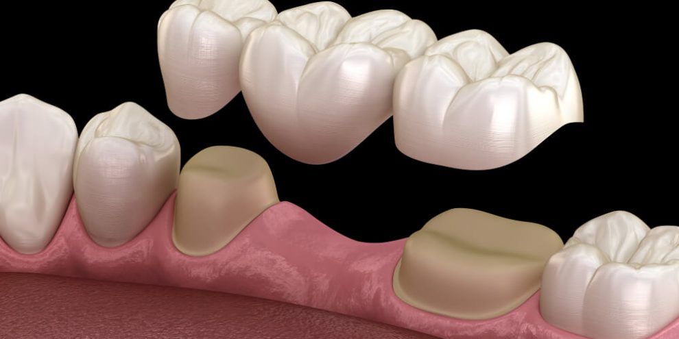Tallado y colocación puente dental