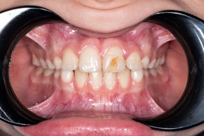 hipoplastia dental tratamiento hipoplastia dental