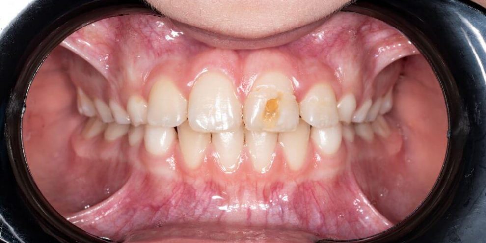 tratamiento hipoplastia dental