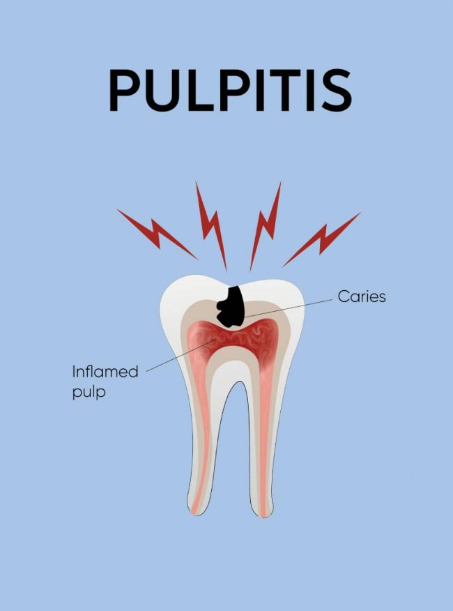 pulpitis pulpitis