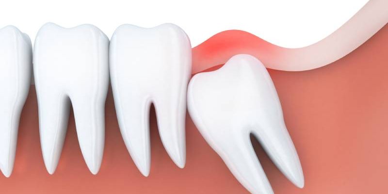 Extracción de las muelas del juicio