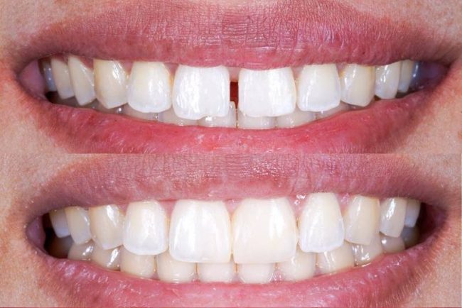 diastema qué es la diastema