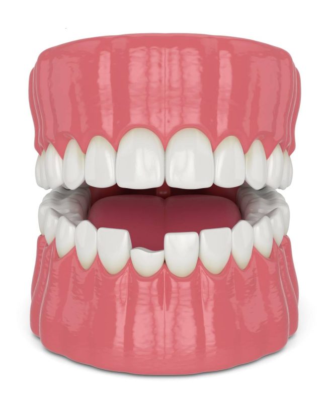 reconstruccion reconstrucción pieza dental