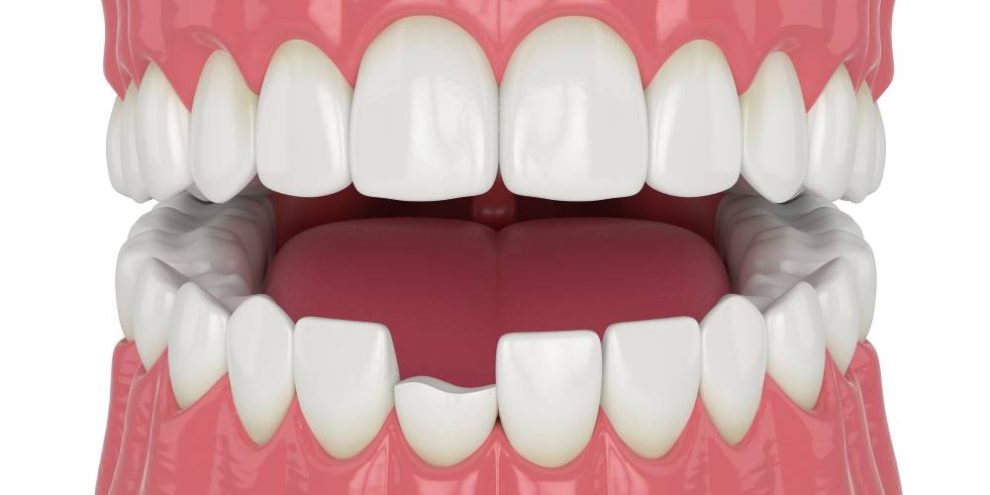 reconstrucción pieza dental