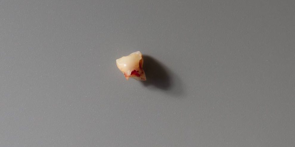 dientes de leche en adultos