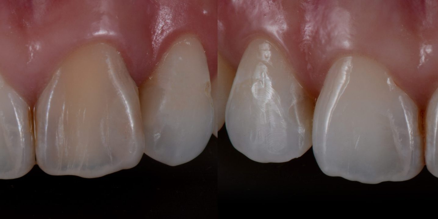 blanqueamiento-interno blanqueamiento-interno