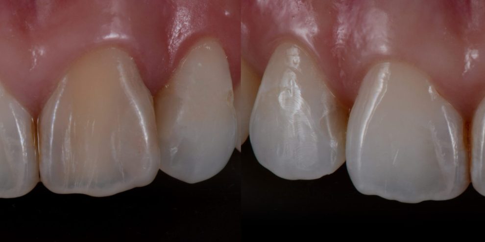 blanqueamiento-interno