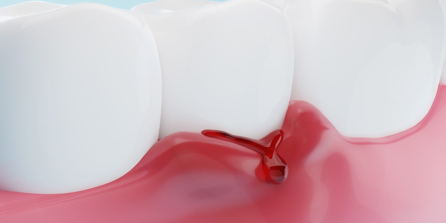 encias sangrando encias sangrando