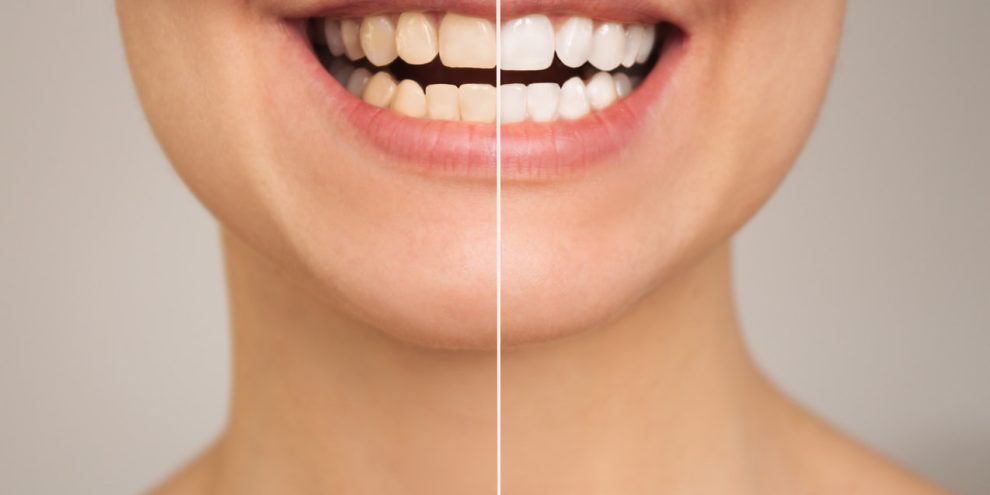 blanqueamiento dental